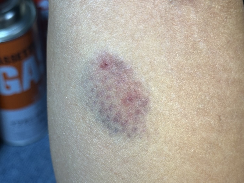 ヒロが犬に噛まれる